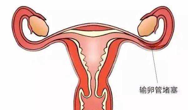 左侧卵巢囊肿是怎么回事该怎么办